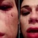 Outspoken Trans Activist Violently Asaulted In Georgia's Capital, Tbilisi